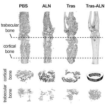 MicroCT scans of rodents show those treated with the conjugate of trastuzumab and alendronate (far right), created at Rice University and Baylor College of Medicine, fared far better than those treated with phosphate-buffered saline (PBS) or alendronate (ALN) or trastuzumab (Tras) alone 82 days after tumor implantation. Courtesy of Baylor College of Medicine/Rice University