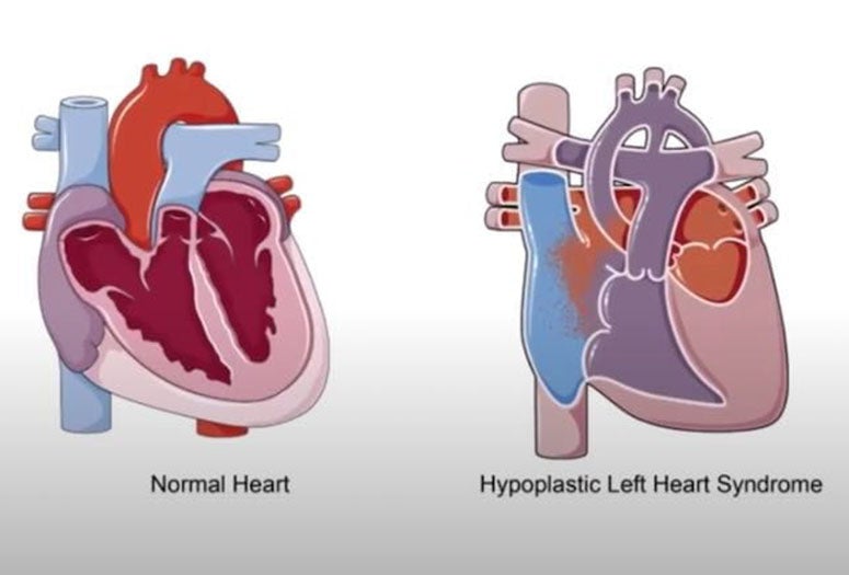 Normal Heart Left. Hypoplastic Left Heart Syndrome Right. 