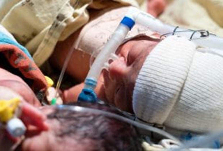 premature baby undergoing treatment