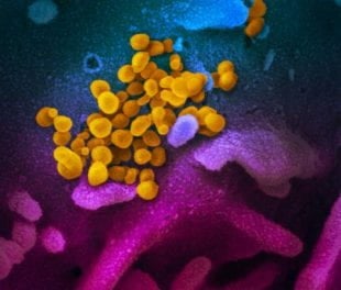 This scanning electron microscope image shows (yellow) the virus that causes COVID-19 isolated from a patient in the U.S., emerging from the surface of cells (blue/pink) cultured in the lab. (Courtesy NIAID RML)