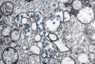 Transmission electron microscopic image of an isolate from the first U.S. case of COVID-19. (Courtesy of CDC)