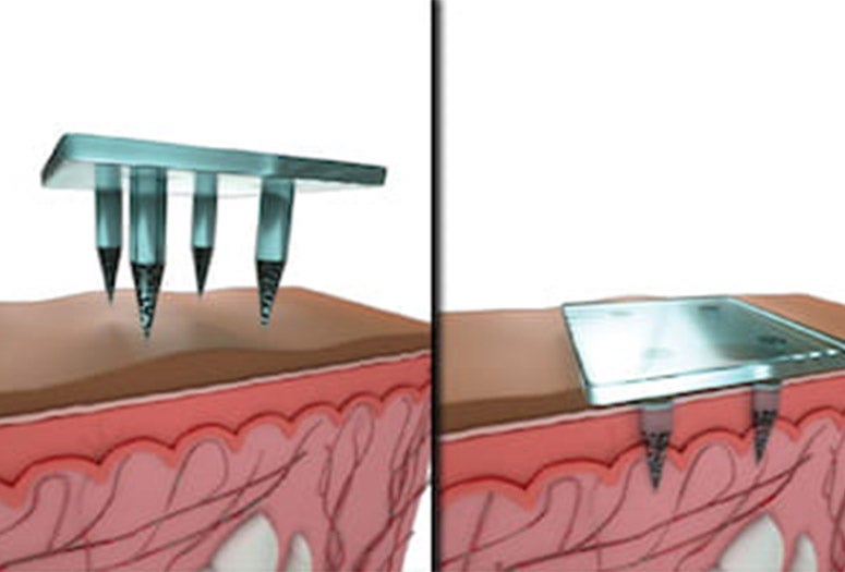 A pattern of 1.5-millimeter microneedles that contain vaccine and fluorescent quantum dots are applied as a patch.