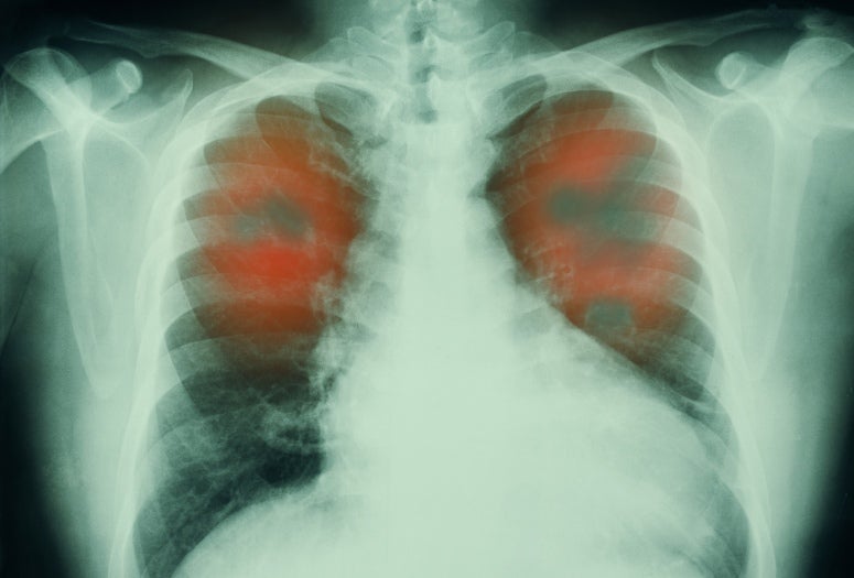 Lung Xray