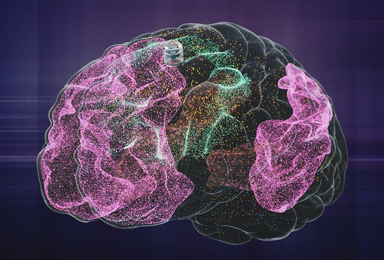 brain graphic courtesy of Motif Neurotech