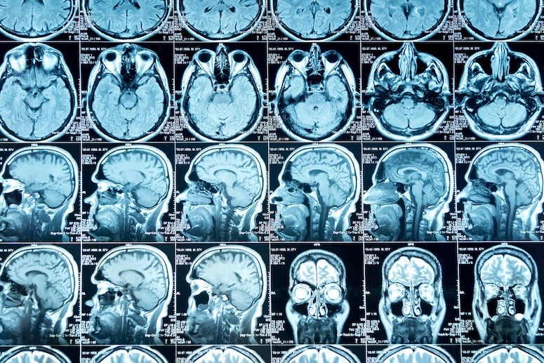 MRI of brains