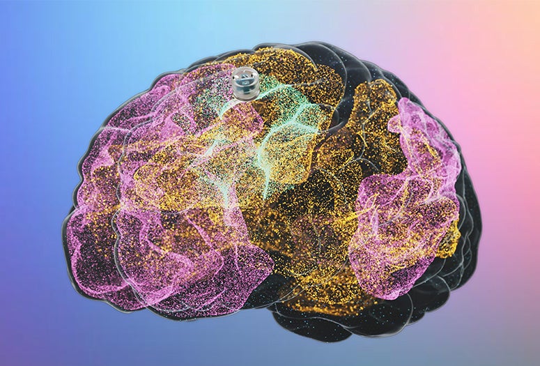 schematic of a brain with a small circular device provided for scale 