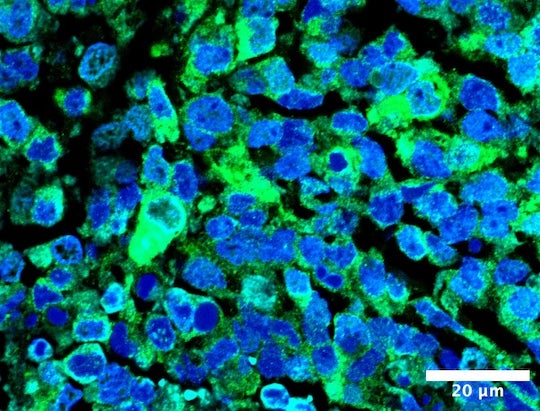 microscopy slide of stained Ewing sarcoma tissue in mouse