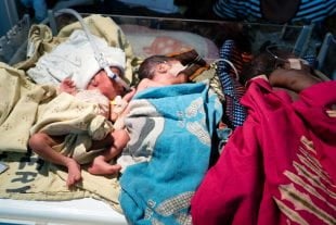 A premature baby receiving treatment from a Pumani CPAP in June 2016