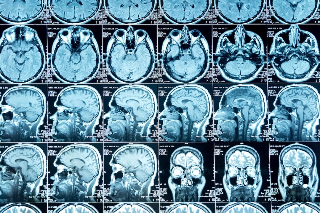 MRI of brain