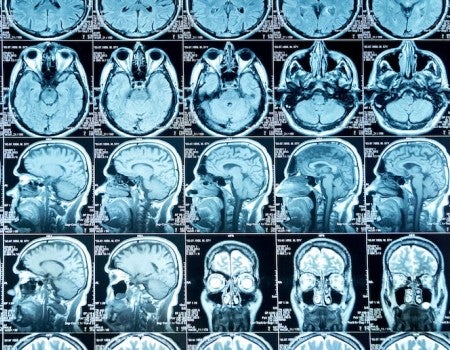 MRI of brains