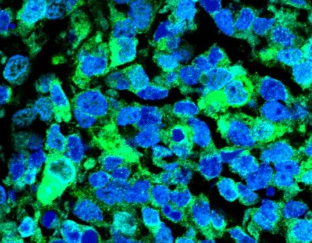 microscopy slide of stained Ewing sarcoma tumor in mouse