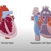 Normal Heart Left. Hypoplastic Left Heart Syndrome Right. 