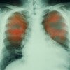 Lung Xray