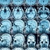 MRI of brains